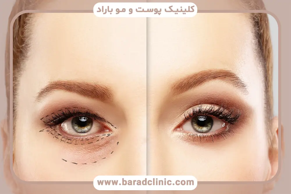 بلفاروپلاستی با لیزر co2