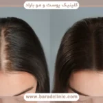 جدیدترین روش کاشت مو بدون بانک مو