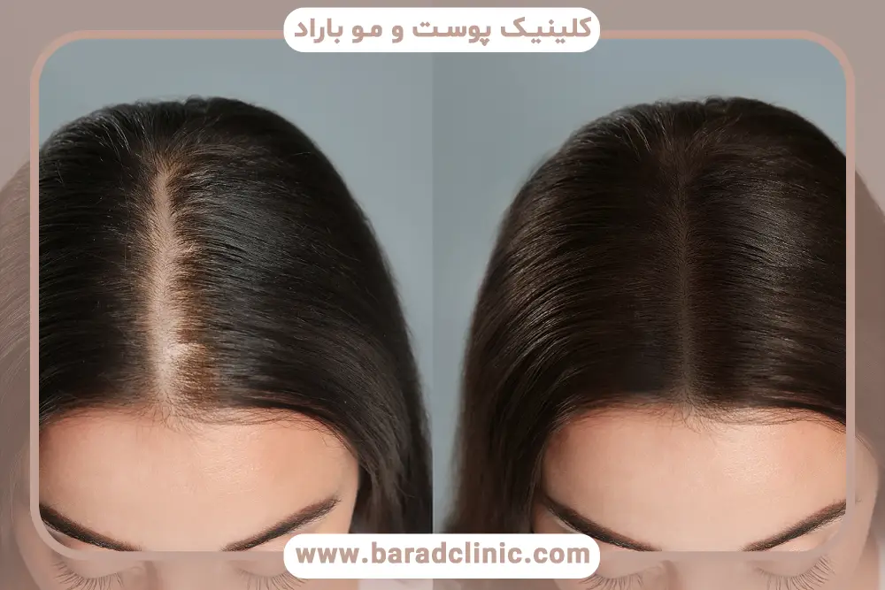 جدیدترین روش کاشت مو بدون بانک مو