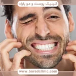 خارش بعد از کاشت ریش