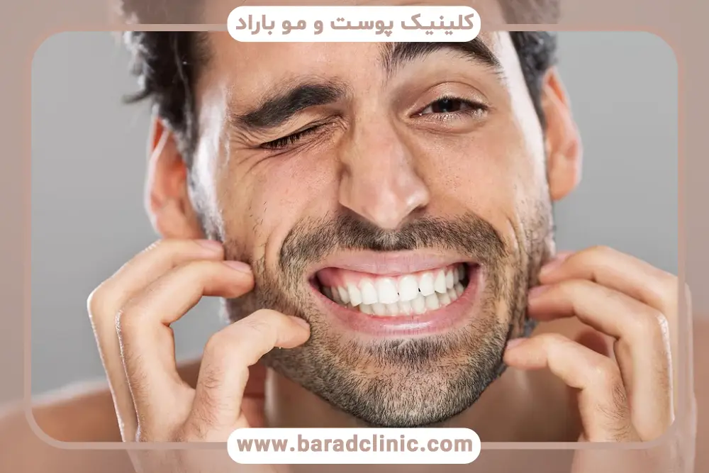 خارش بعد از کاشت ریش