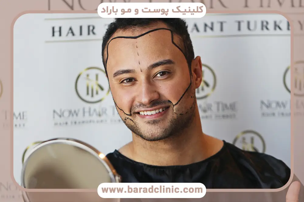 کاشت ریش وی ای پی