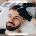 مزو تراپی بعد از کاشت مو