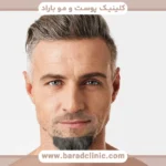 کاشت ریش چانه