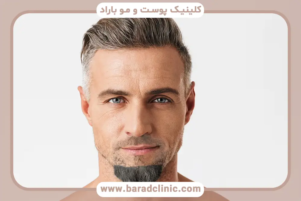 کاشت ریش چانه