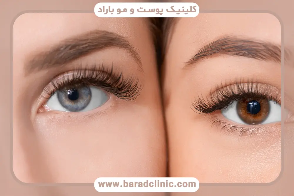 جایگزین بلفاروپلاستی