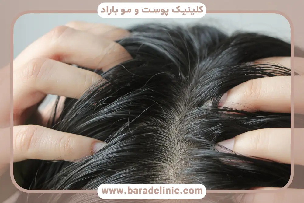 خارش سر بعد از کاشت مو