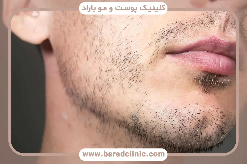 کاشت ریش موضعی