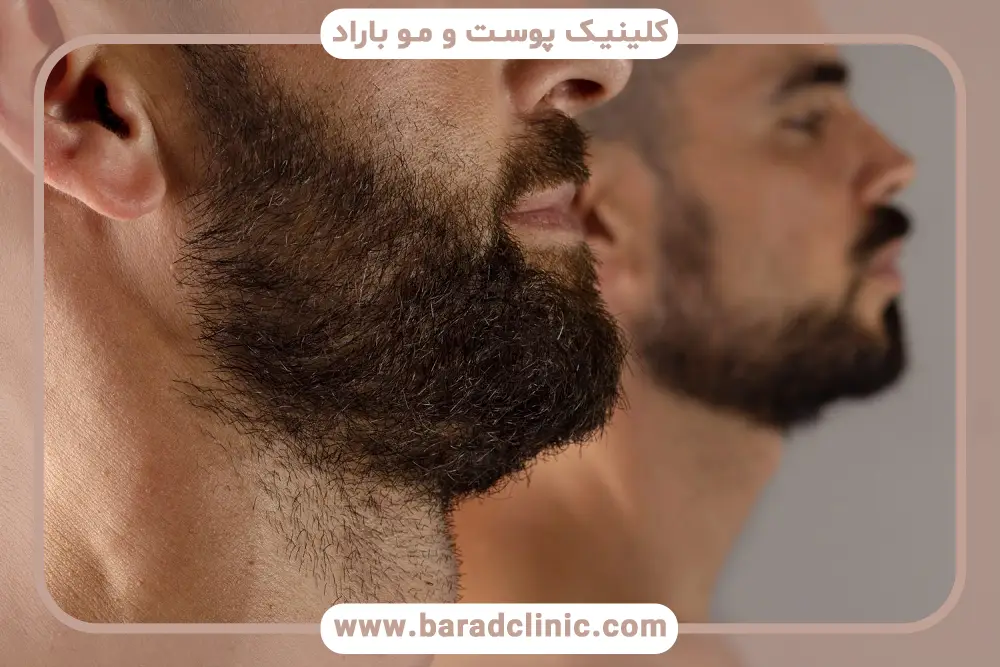 کاشت تخصصی ریش