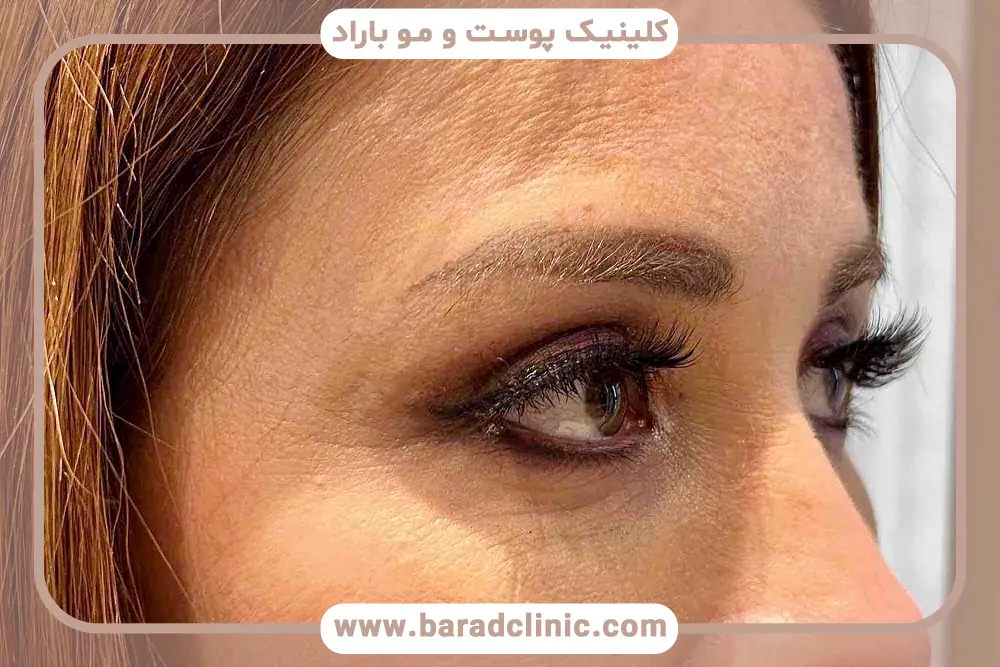 بلفاروپلاستی ترمیمی