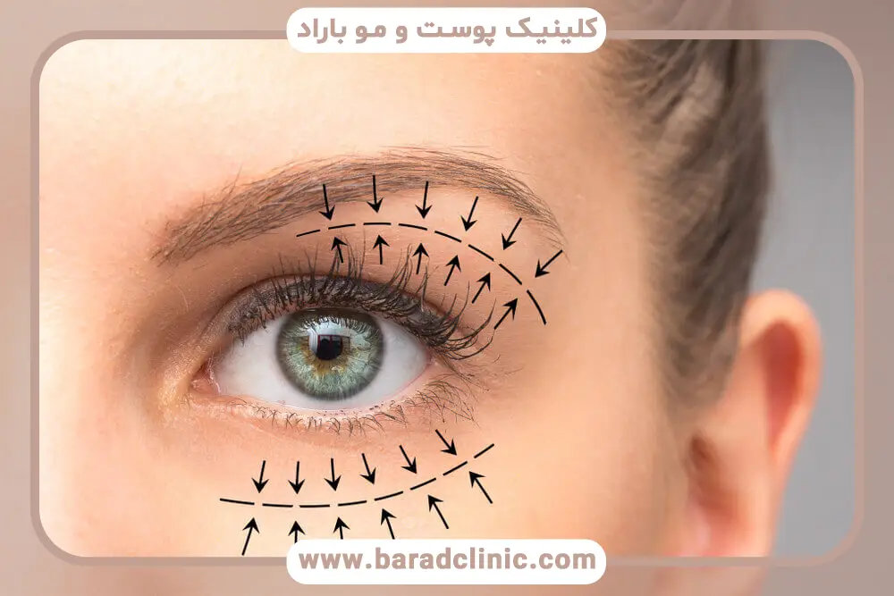 بلفاروپلاستی ترانس کونژ