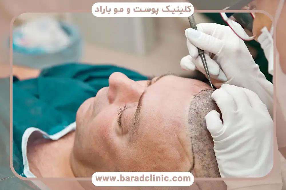 تصاویر کاشت مو