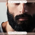 کاشت ریش جای سوختگی