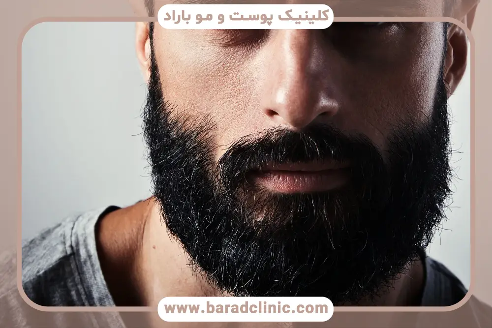 کاشت ریش جای سوختگی