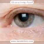 بلفاروپلاستی چقدر ماندگاری دارد