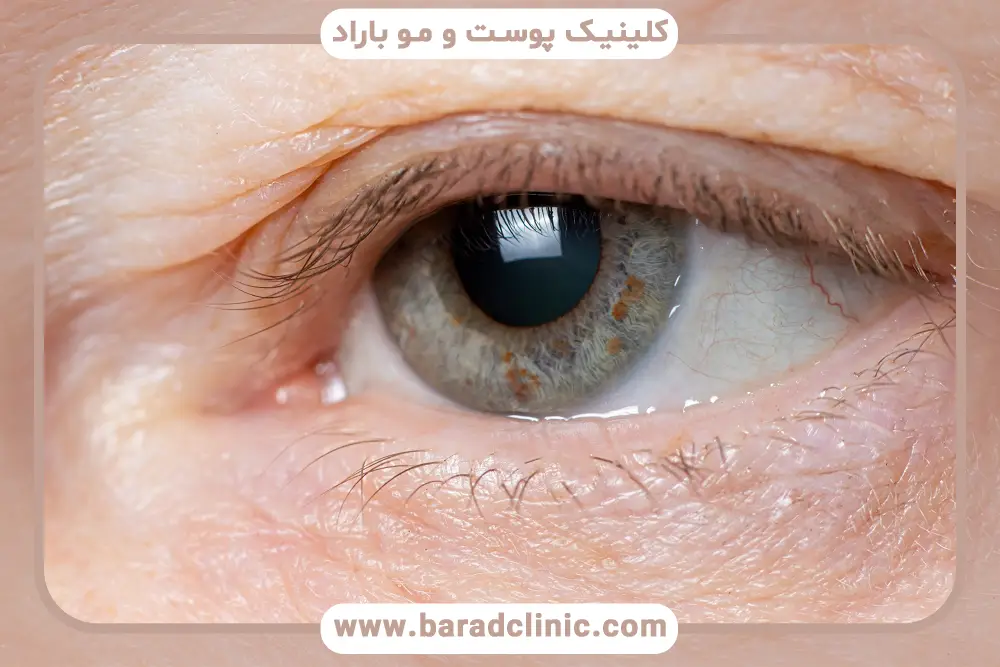 بلفاروپلاستی چقدر ماندگاری دارد