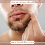 کاشت ریش با لیزر