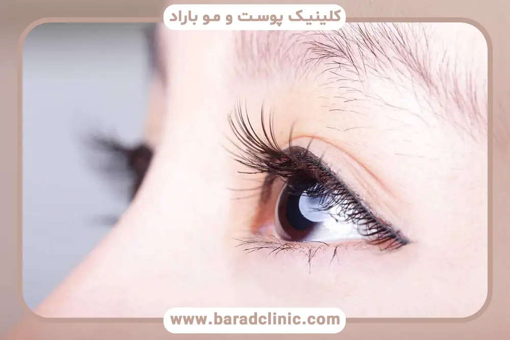 بلفاروپلاستی اقساطی