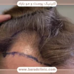 کاشت مو به روش dhi