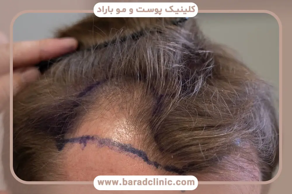 کاشت مو به روش dhi