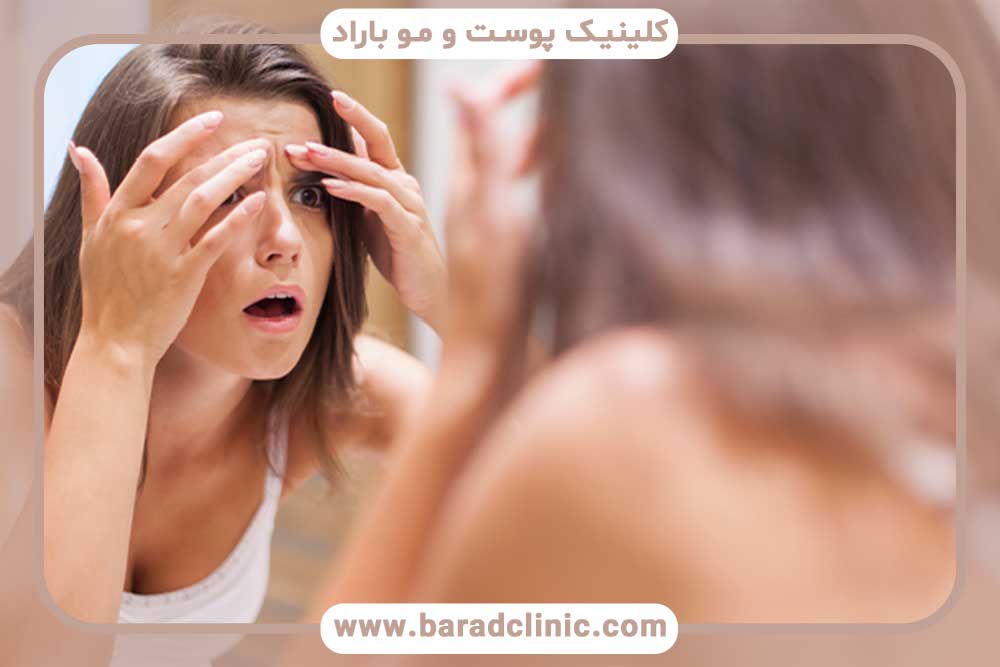 جوش بعد از کاشت ابرو