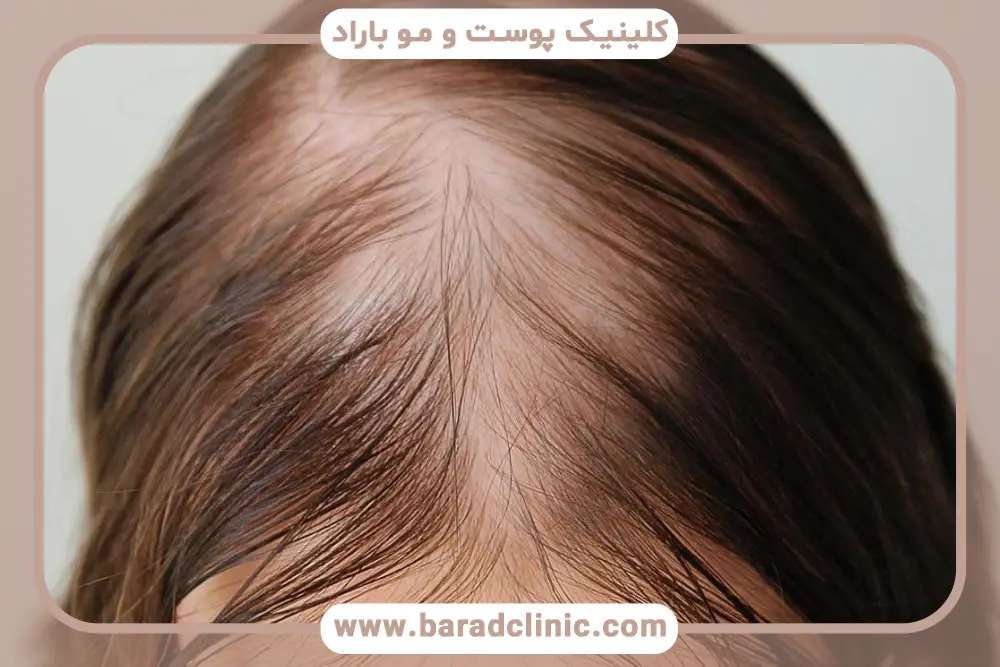 فیلم ترمیم مو به روش مایکروپوینت