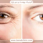 عکس بلافاصله بعد از عمل بلفاروپلاستی