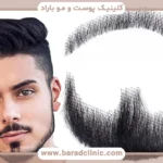 کاشت ریش مصنوعی