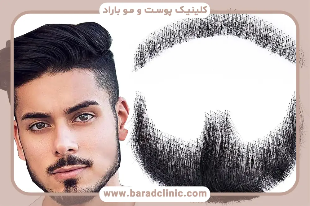 کاشت ریش مصنوعی