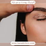 احساس کشیدگی پلک بعد از بلفاروپلاستی