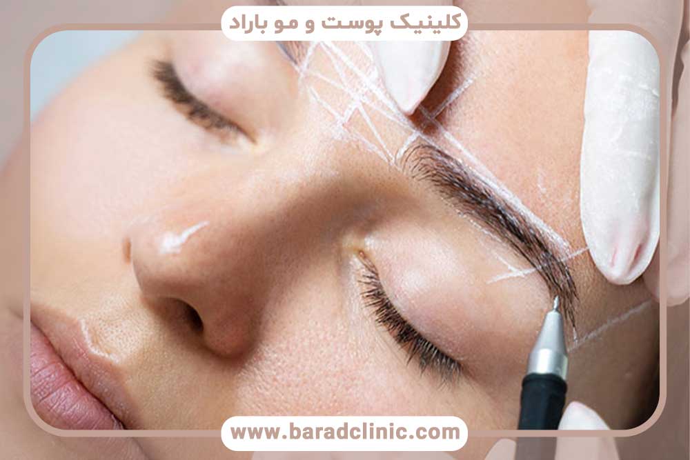 کاشت ابرو جاهای خالی