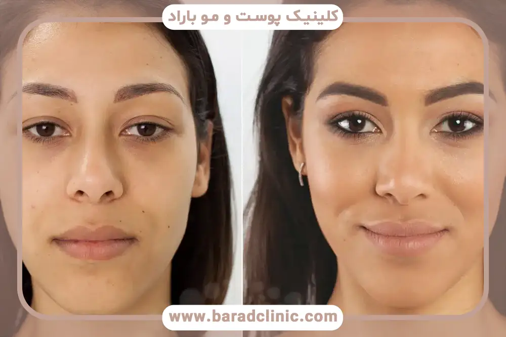 بلفاروپلاستی پلک بالا با لیزر