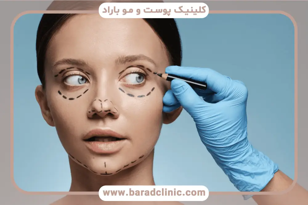 بلفاروپلاستی چشم