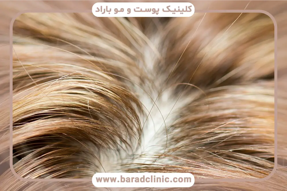 تفاوت مایکروپوینت موی سر با کاشت مو