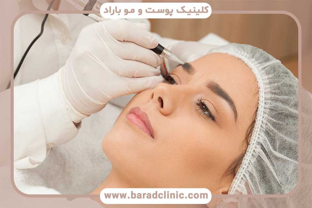 کاشت ابرو با جراحی یا بدون جراحی