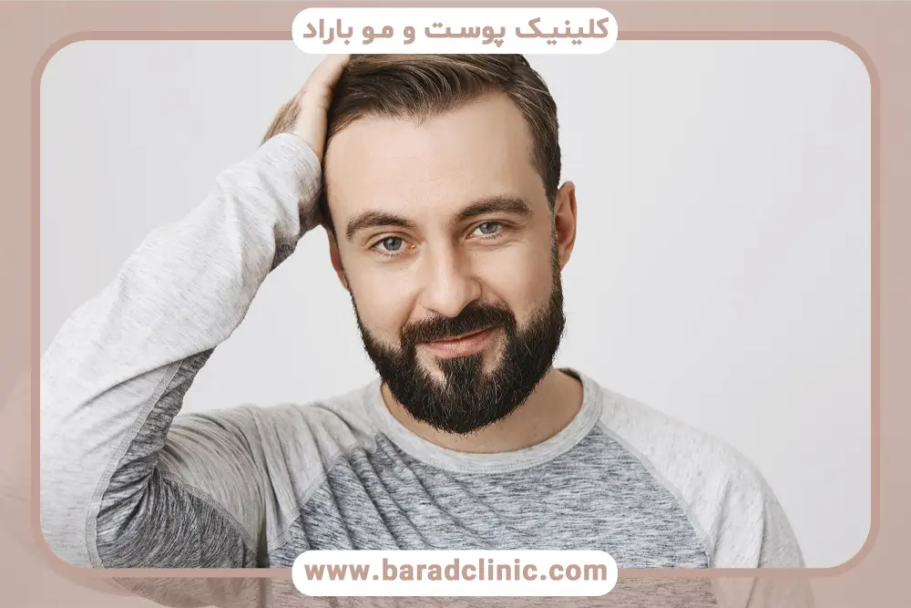 انواع روش‌های کاشت ریش مردان