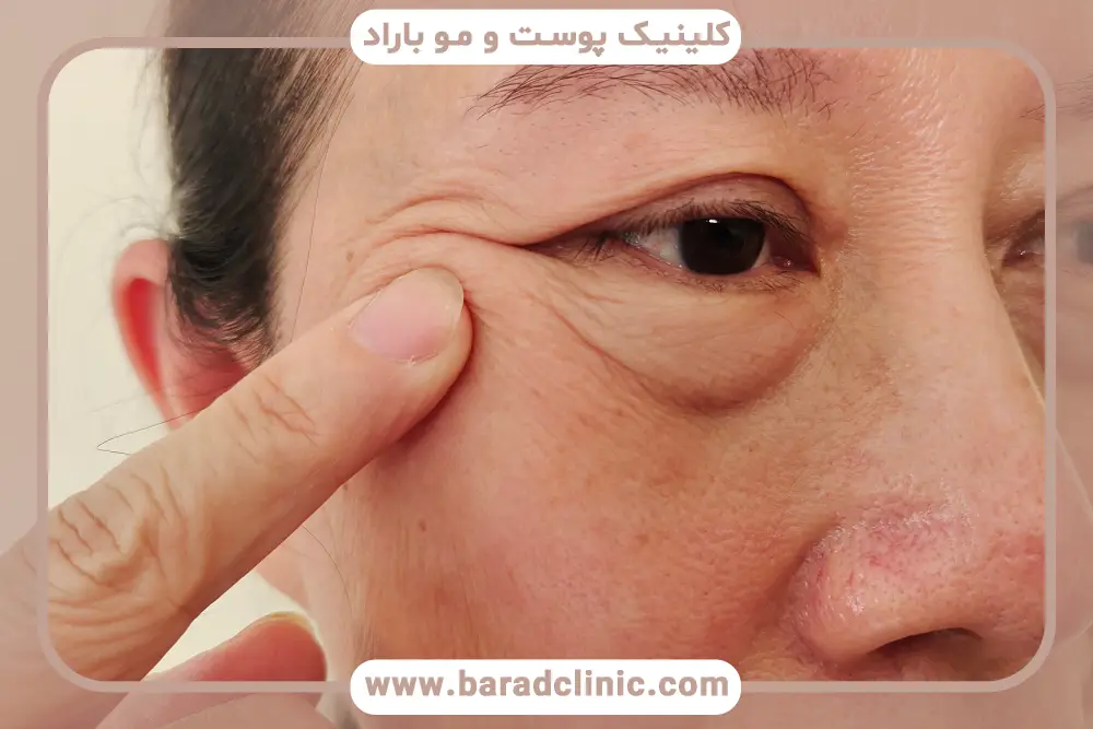 کاندیدای مناسب بلفاروپلاستی پف زیر چشم 