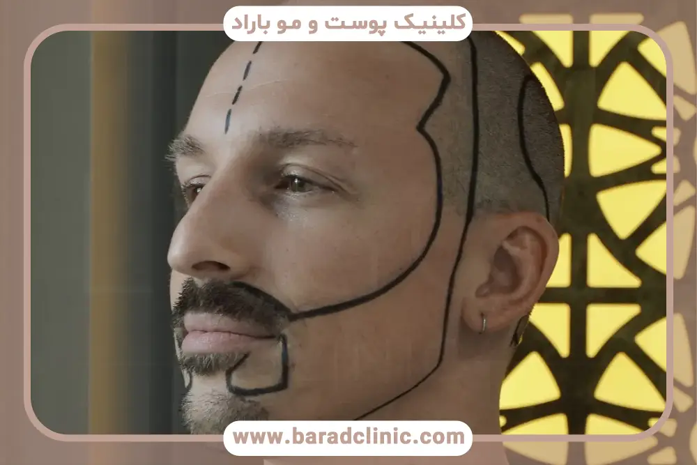 مراحل و پروسه کاشت ریش 