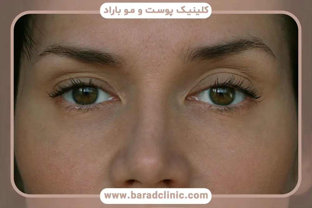 آشنایی با بلفاروپلاستی پلک بالا 