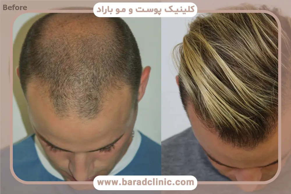 روش FUT از انواع کاشت مو 