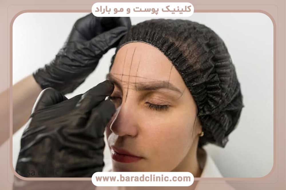 کاشت ابرو لیزری