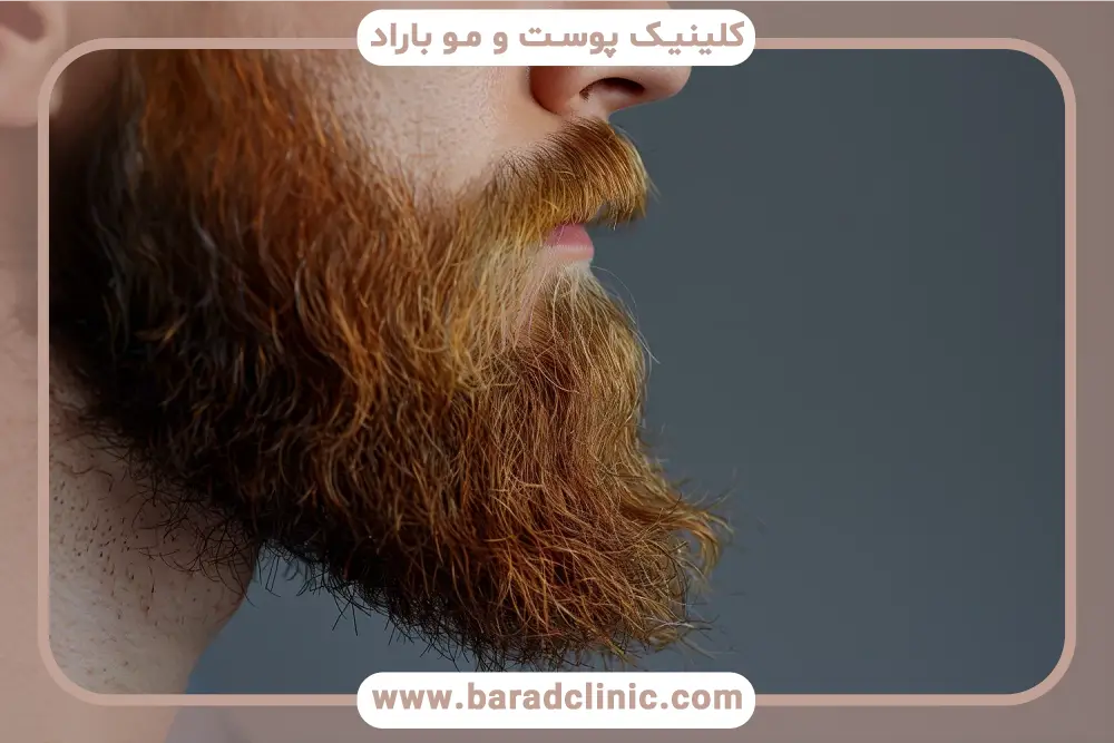 کاشت ریش در خانه واقعیت دارد؟ 
