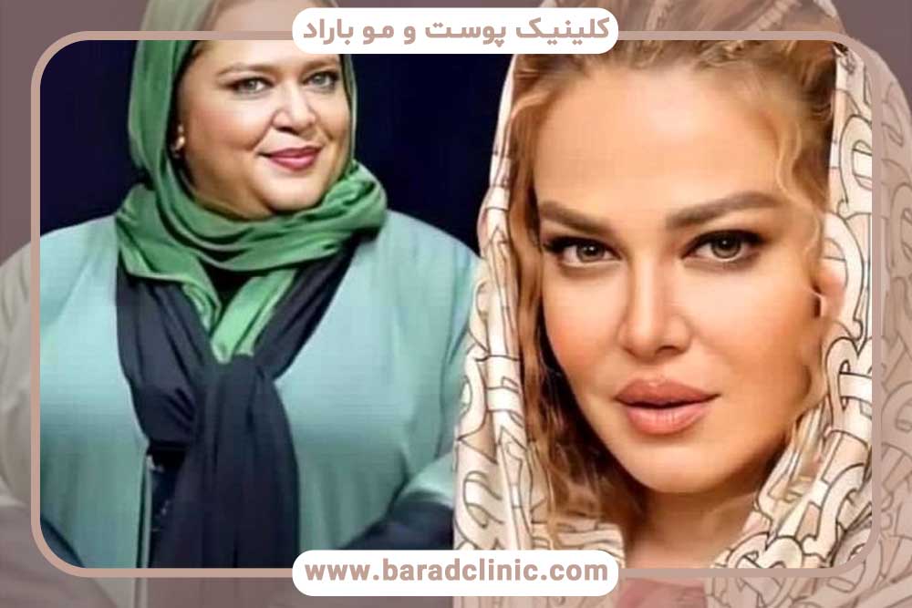 کاشت ابرو بازیگران