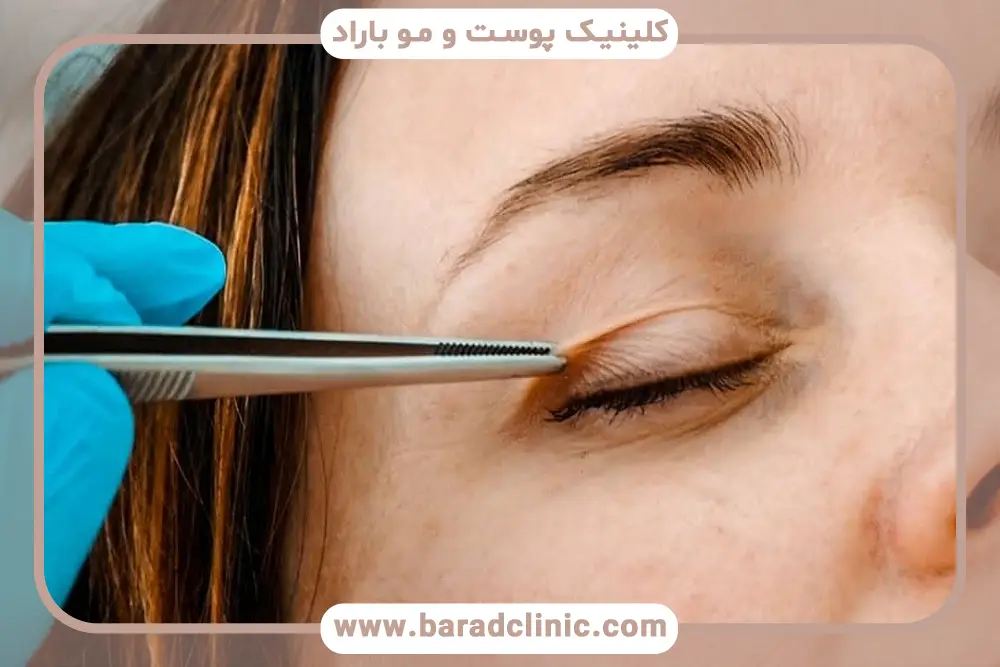 دلایل انجام بلفاروپلاستی پلک