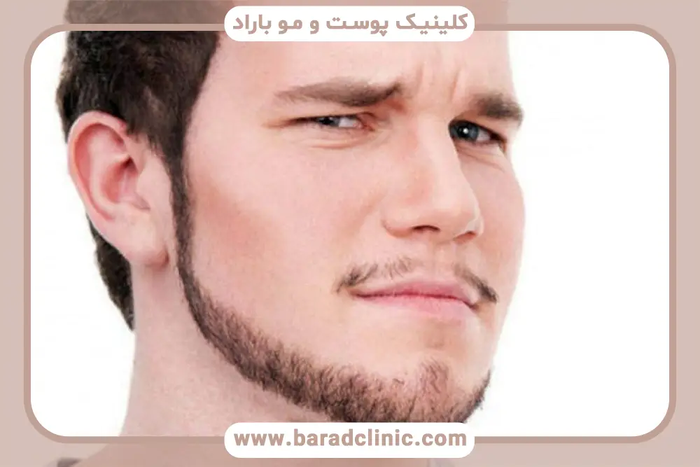 خدمات کاشت ریش کم پشت