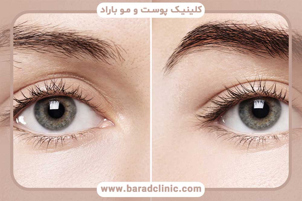 کاشت ابرو و کم خونی