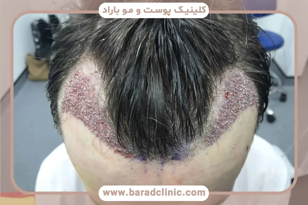 مزایای کاشت مو در ایران 