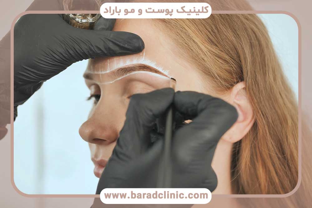 کاشت ابرو و پسوریازیس