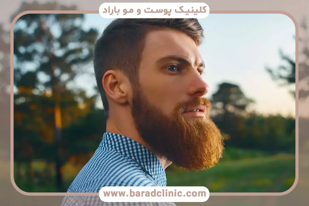 واقعیت کاشت ریش موقت 