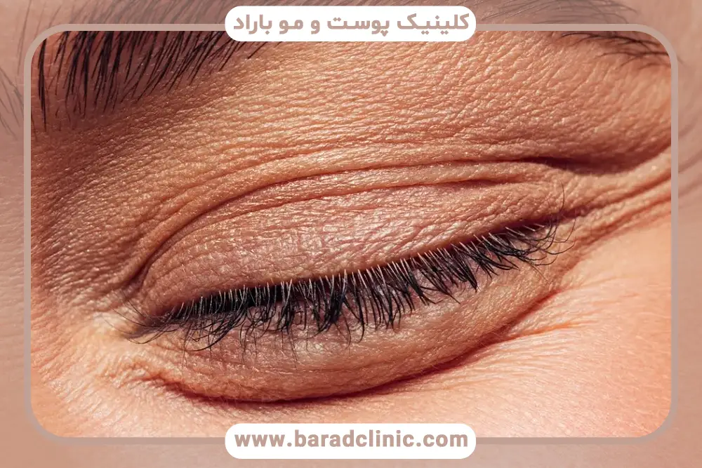 دلایل ایجاد گوشت اضافه بعد از بلفاروپلاستی 